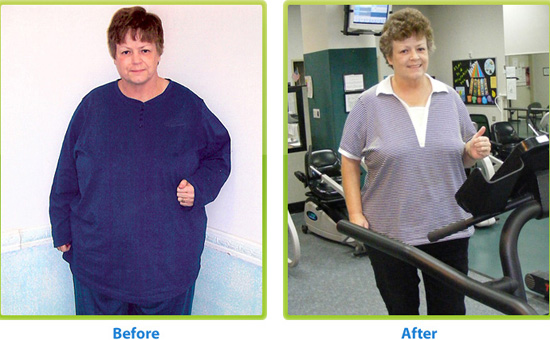 Before and after weight loss surgery